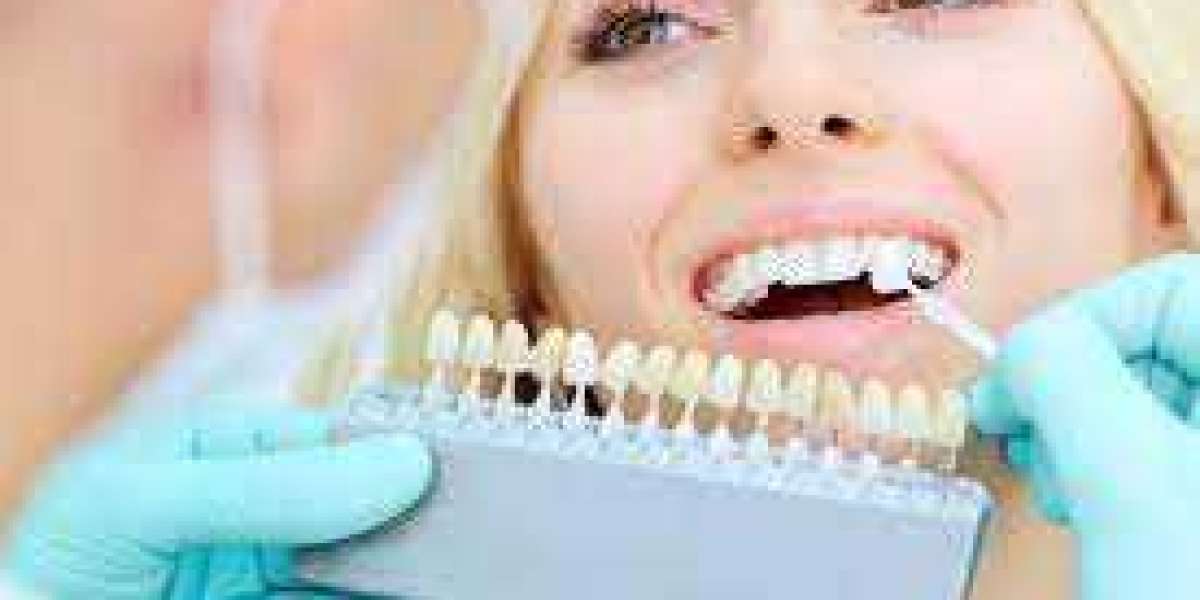 Things You Should Know About Teeth Whitening 1: