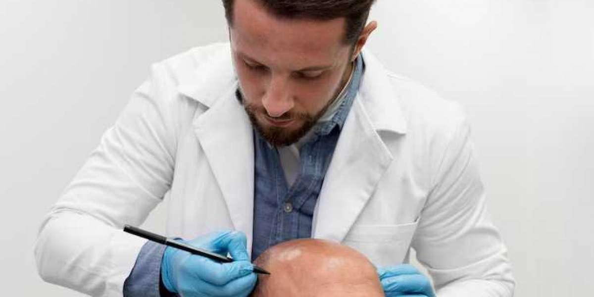 Discover the Magic of Smart FUE Hair Transplant in Beverly Hills