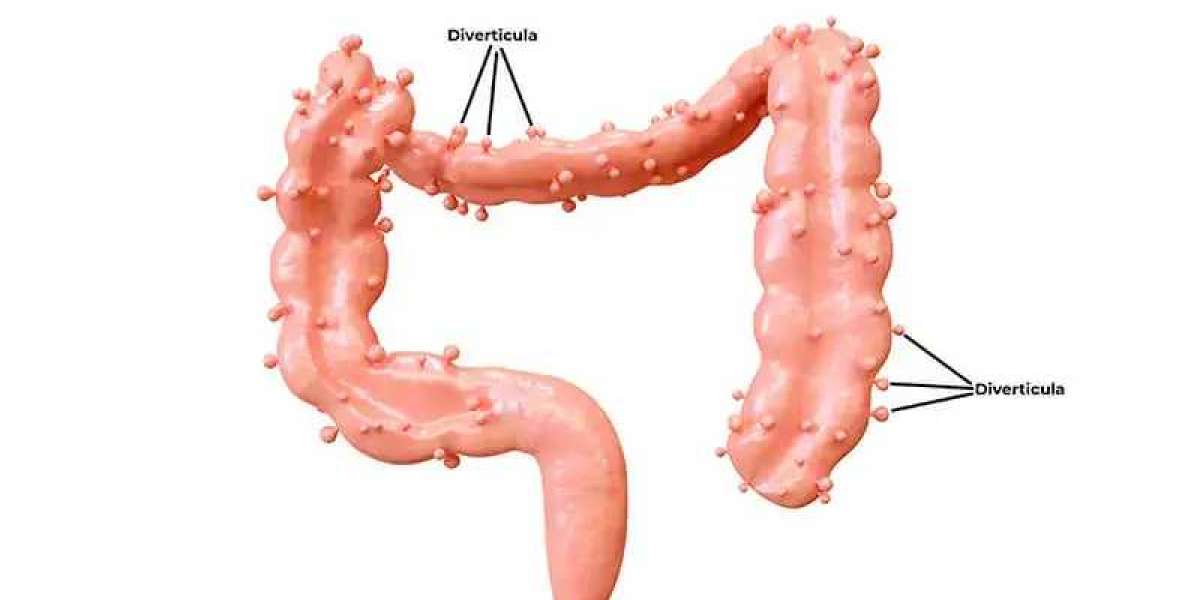 What are the symptoms of diverticular disease?