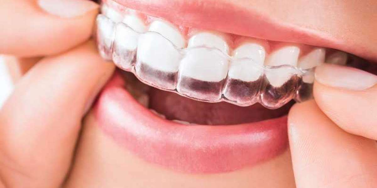 The Ultimate Guide to Clear Aligners