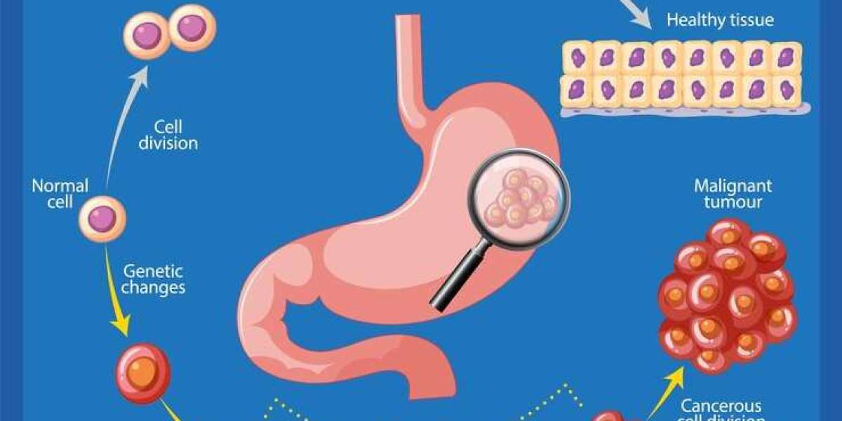 GI Cancer Surgery in Bangalore – Expert Treatment by Dr. Bhushan Chittawadagi