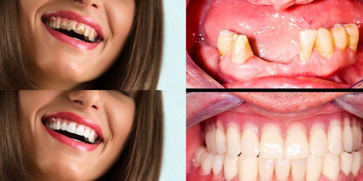 Full Mouth Reconstruction: Rebuild Your Smile with Expert Dental Care