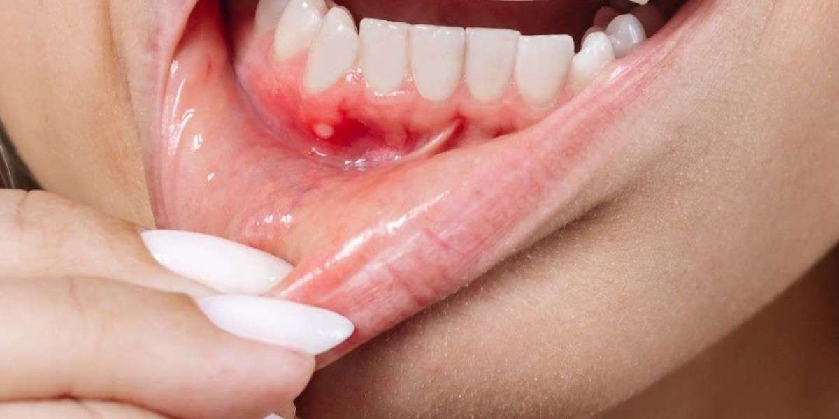 Periodontal Pockets, Abscesses, and Gum Recession: Understanding Holes in the Gum