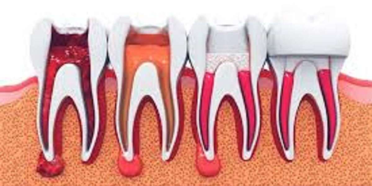 root canal treatment in adliya