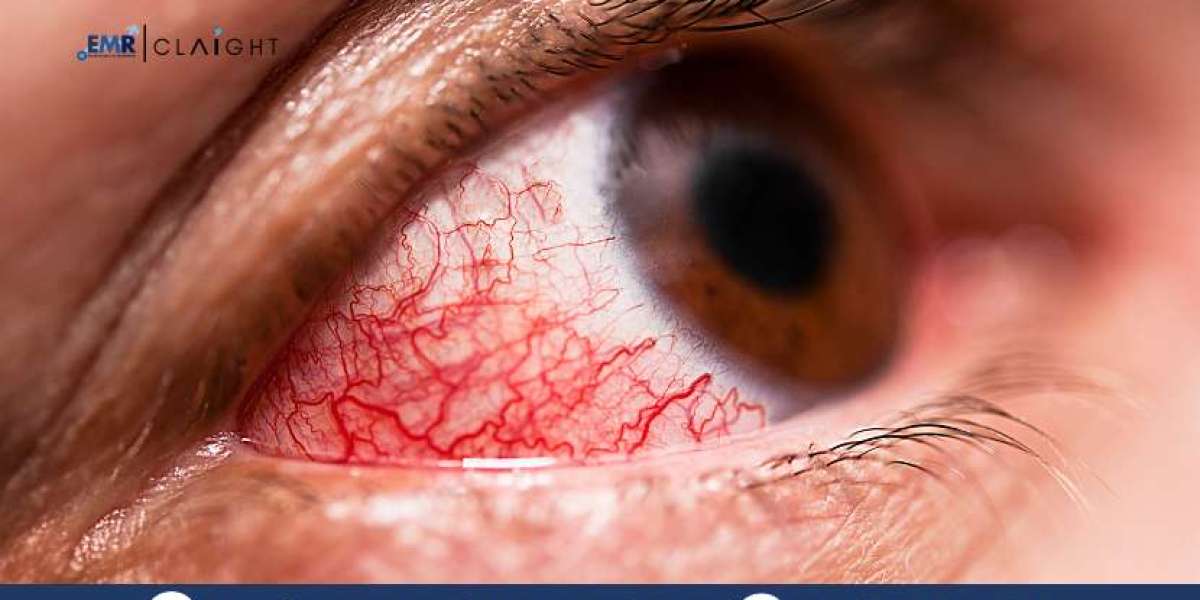 Vernal Keratoconjunctivitis Market – Industry Analysis & Future Insights 2034