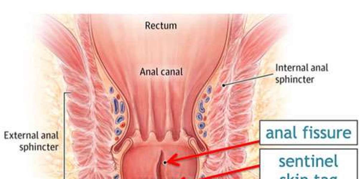 Find the Best Fissure Treatment in Bangalore with Dr. Bhushan Chittawadagi