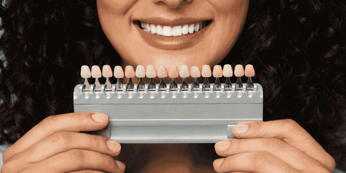 Dental Veneers Treatment : process & How Long Does It Take?