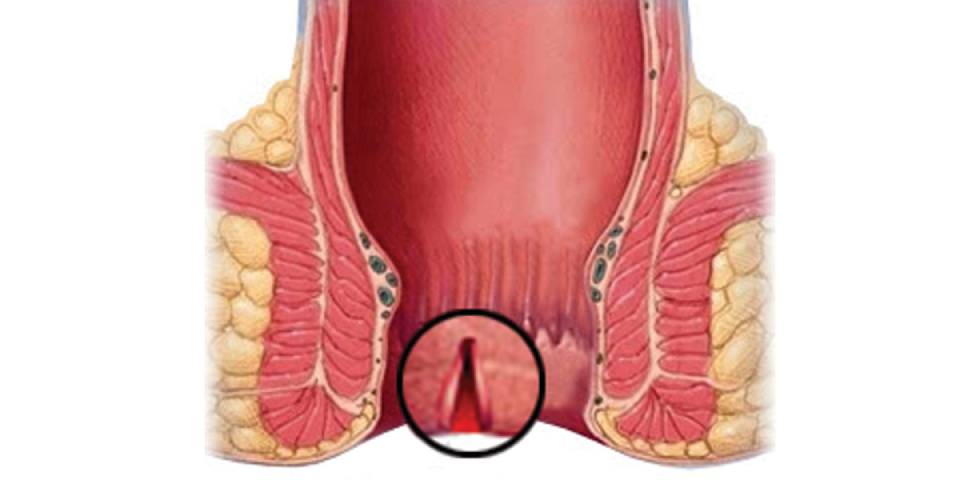 Best Anal Fissure treatment In Bangalore | Anal Fissure Specialist In Banglore- Dr Bhushan Chittawadagi