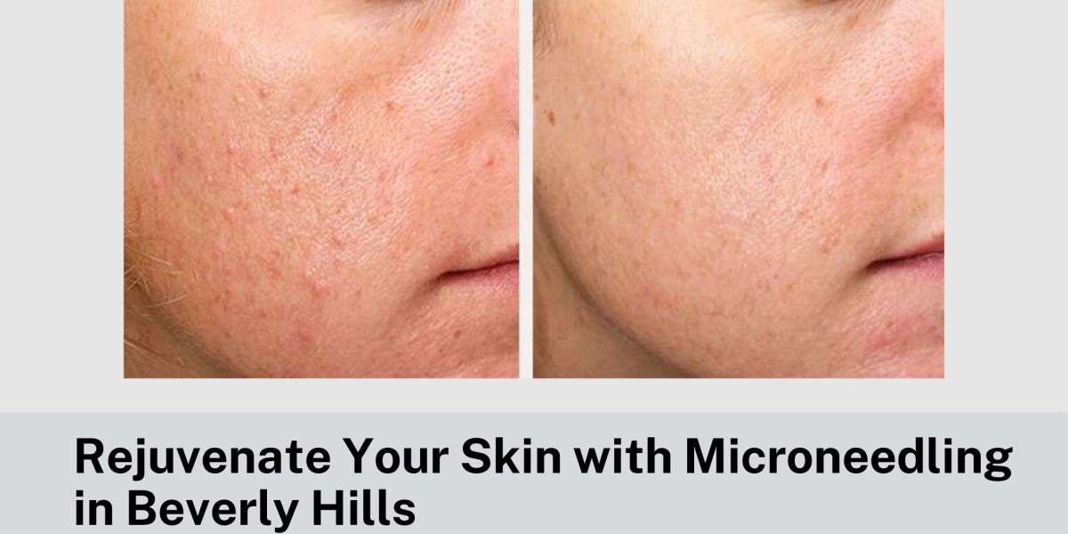 Rejuvenate Your Skin with Microneedling in Beverly Hills