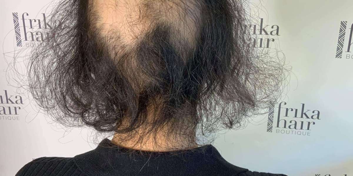 Regain Confidence with Natural-Looking Wigs for Hairloss
