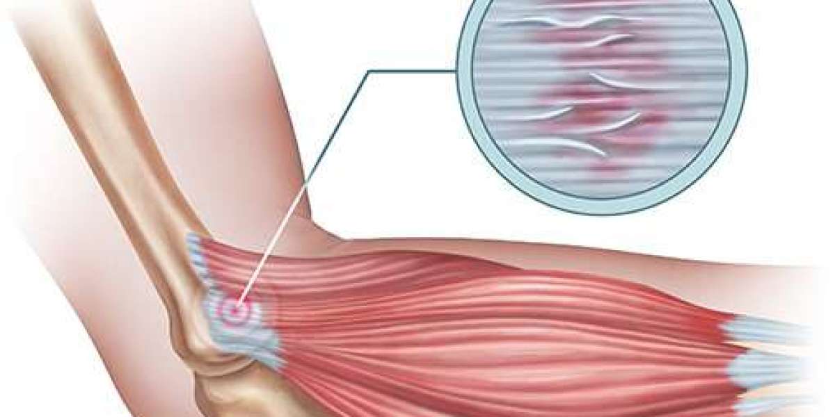 Stem Cell Therapy for Elbow Pain: A Natural Path to Relief and Recovery