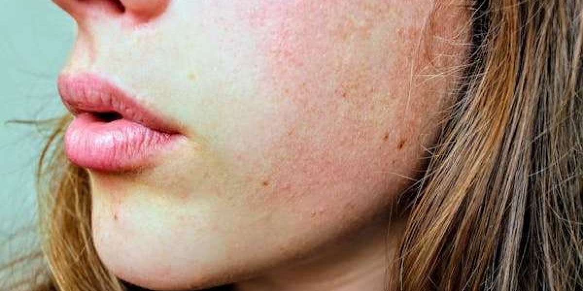Achieve Naturally Radiant Lips with Lip Pigmentation Removal in Bangalore