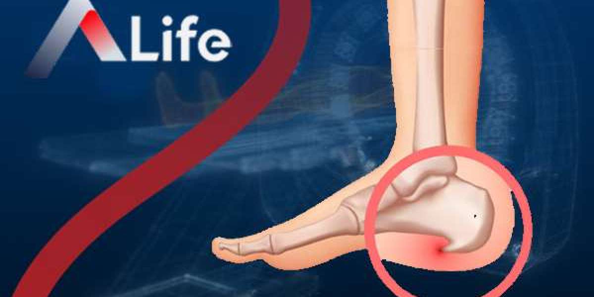 Why Heel Spurs Happen and How to Prevent Them