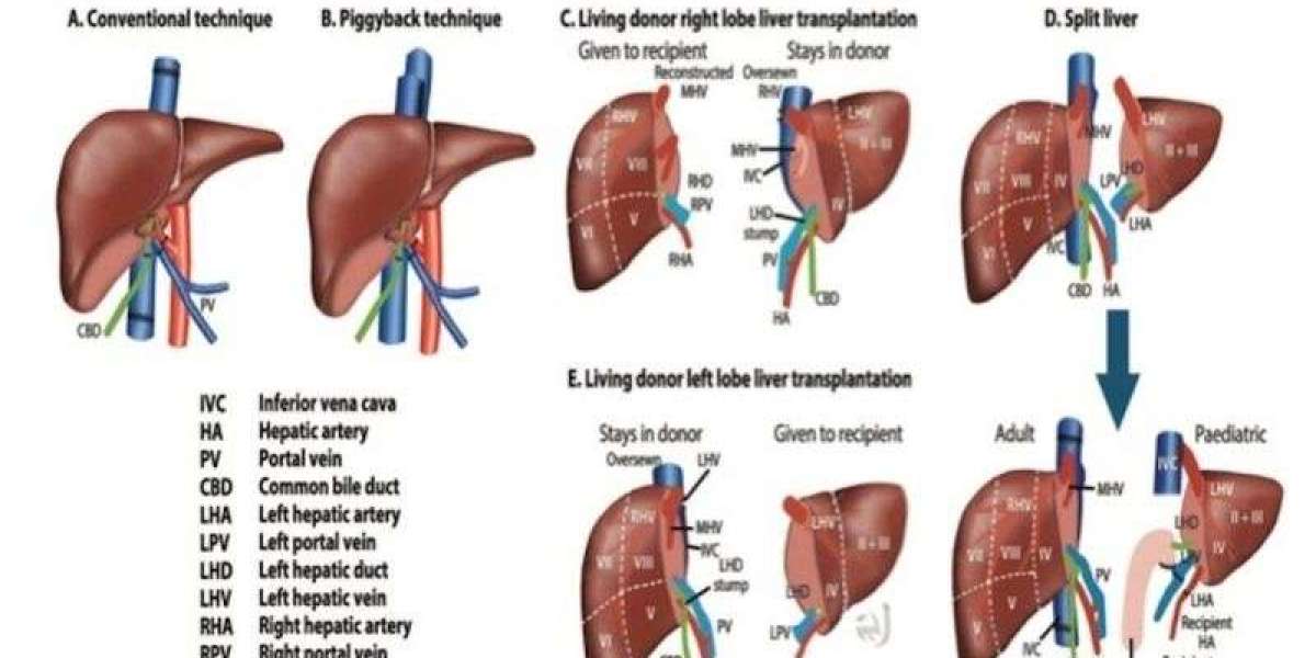 Laparoscopic Liver Surgery in Bangalore – Dr. Bhushan Chittawadagi's Expert Services
