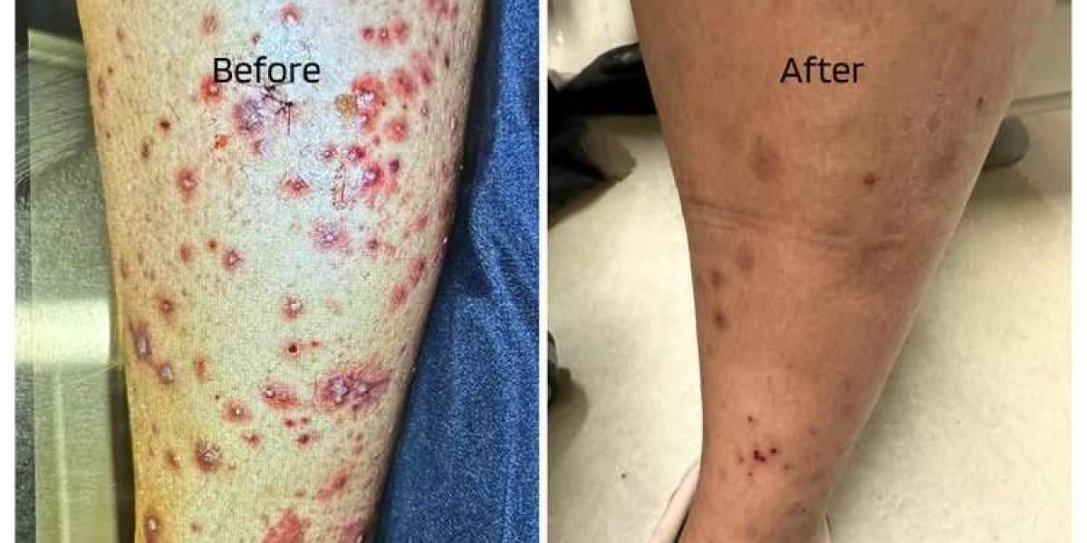 Gentle, Effective Body Creams for Eczema Relief
