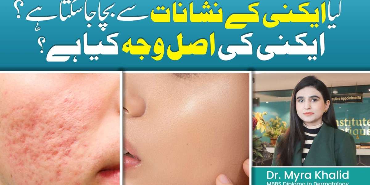 How to Get Rid of Acne for Good at Home