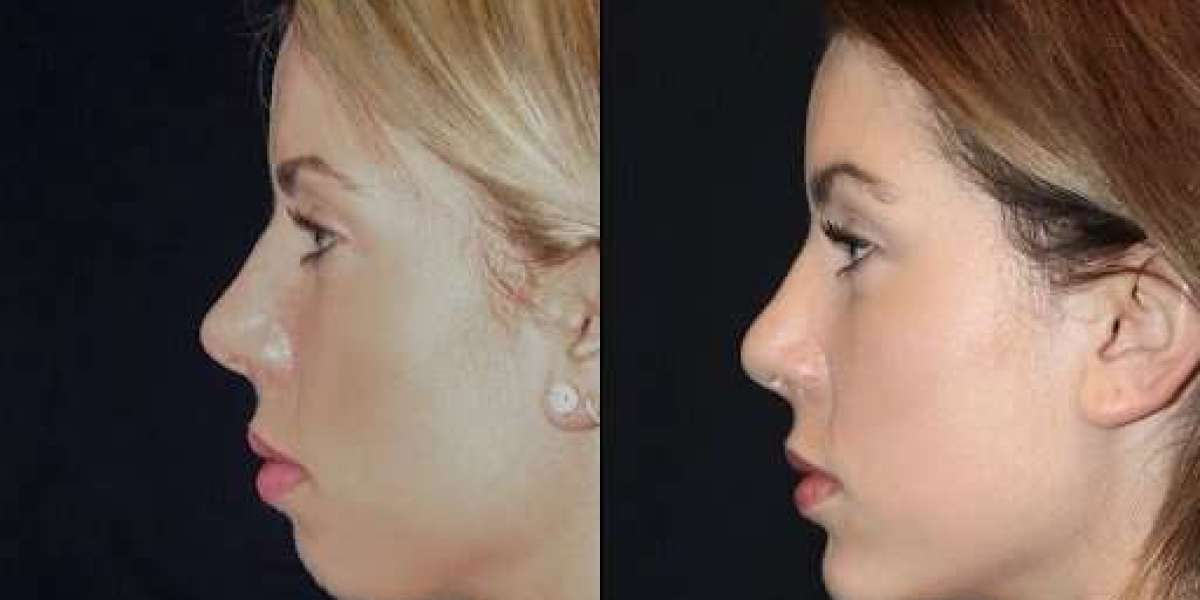 Chin Fillers Treatment in Dubai: Enhancing Your Confidence