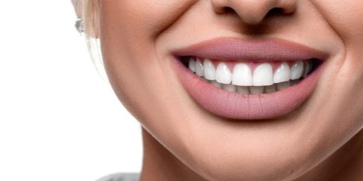 Hollywood Smile Makeover in Dubai: Shine Like a Celebrity