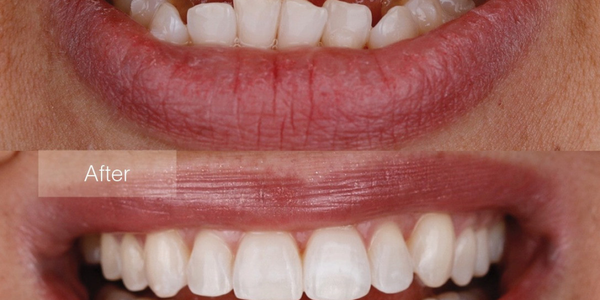 The Ultimate Guide to Children's Dental Braces and Teeth Straightening Solutions