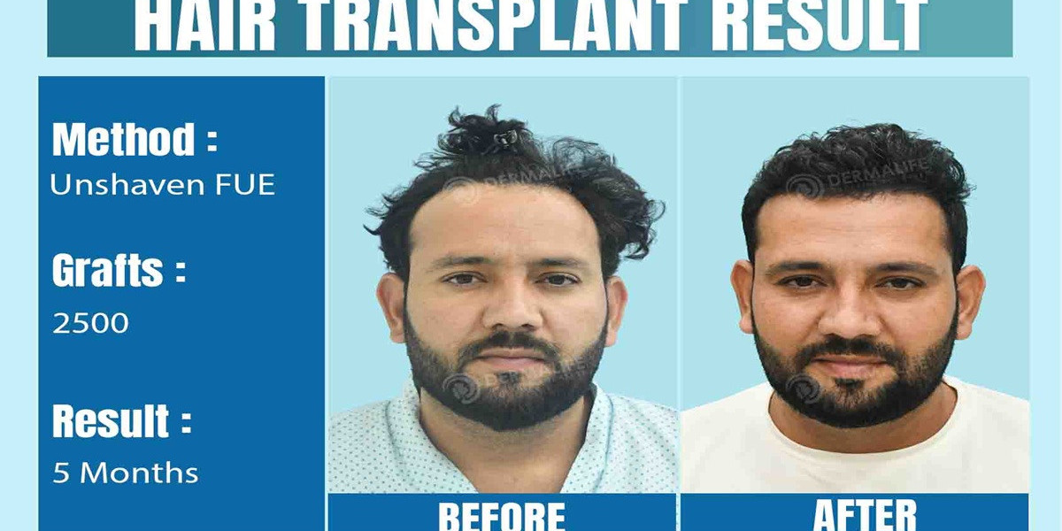 Understanding Hair Transplant Cost in Delhi: