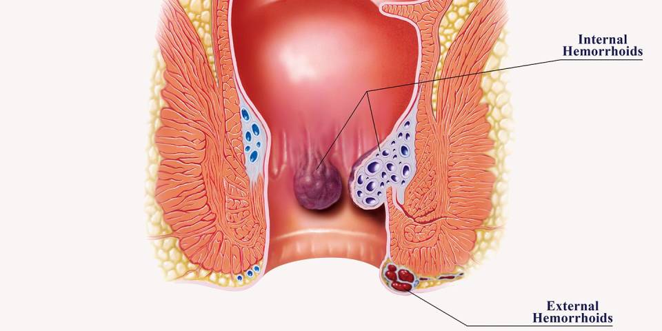 Best Piles Specialist in Chennai | Piles Treatment in Chennai - Dr. Pinak Dasgupta
