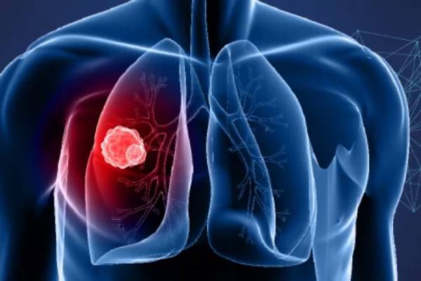 Lung Cancer Surgeon in Hyderabad | Caner Treatment Secunderabad