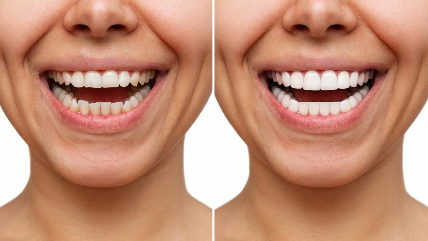 Bright Smiles Dental – Trusted Veneers Dentist in Newton, Highton, and Geelong West for a Flawless Smile