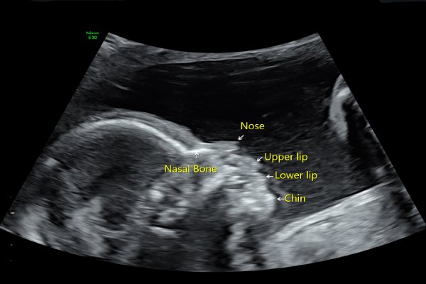 Absent Nasal Bone Treatment in Pune | Dr. Deepti Mittal