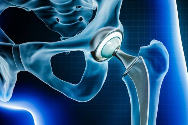 Best Hip Replacement Surgery in PCMC – Ayush Orthopaedic Clinic