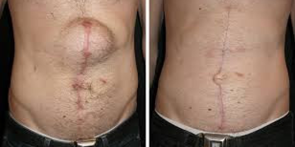 Hernia Surgery in the UK: Modern Treatments for a Common Condition