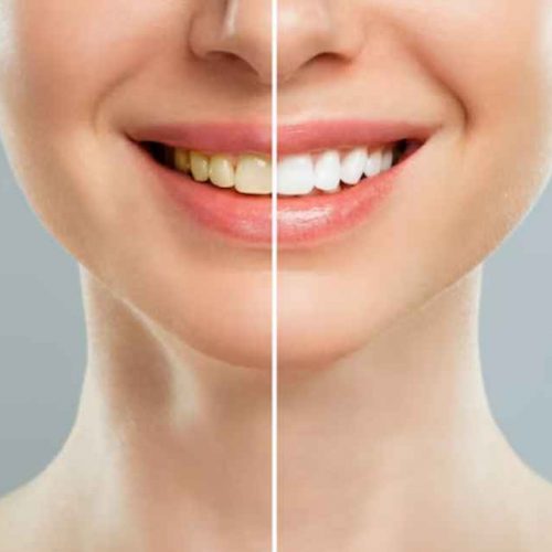 Teeth Whitening in Ajman | Brighten Your Smile Today