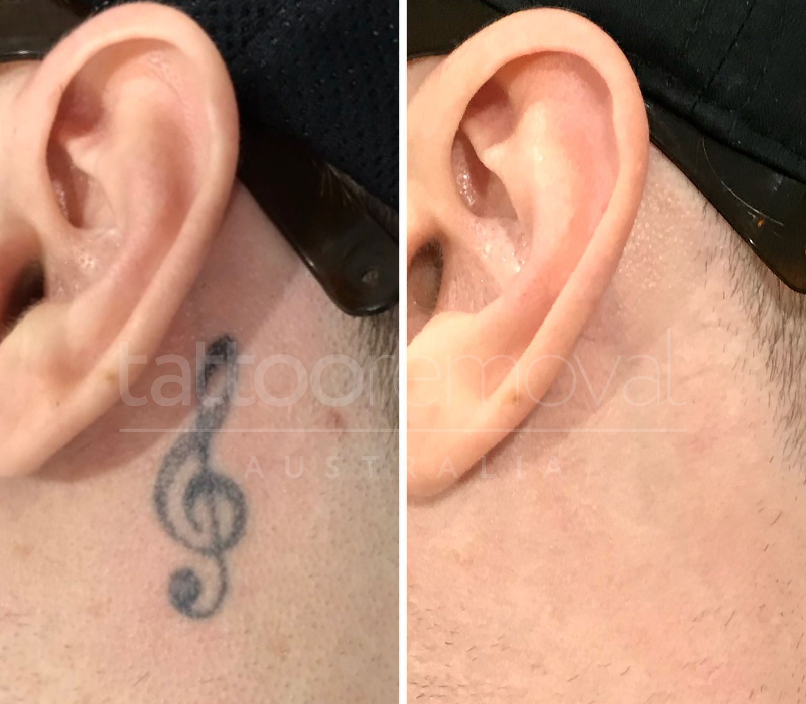 Tattoo Removal Cream vs Laser Treatment | Full Guide
