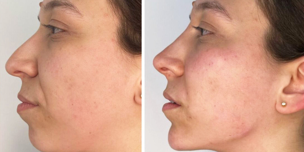 Endolift Laser Dubai: The Quiet Fix People Pretend They “Just Noticed”