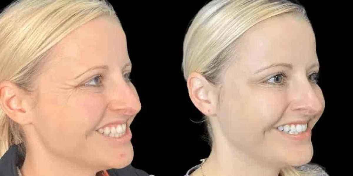 Best Doctors in Dubai for Botox for Smoother, Younger-Looking Skin