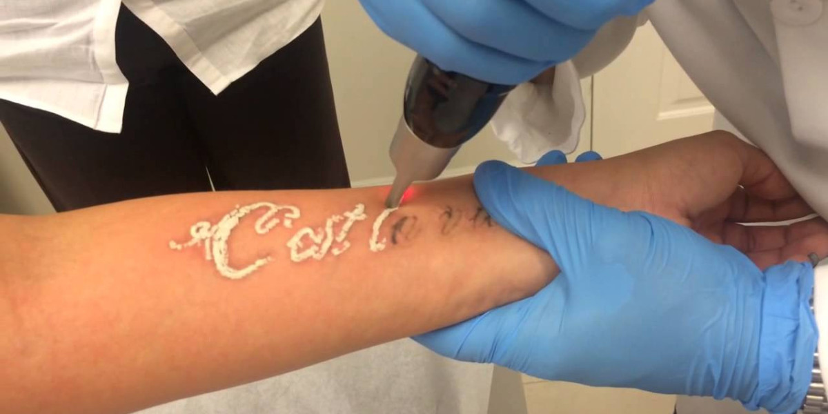 Picosure Tattoo Removal In Islamabad: Everything You Need to Know Before Treatment