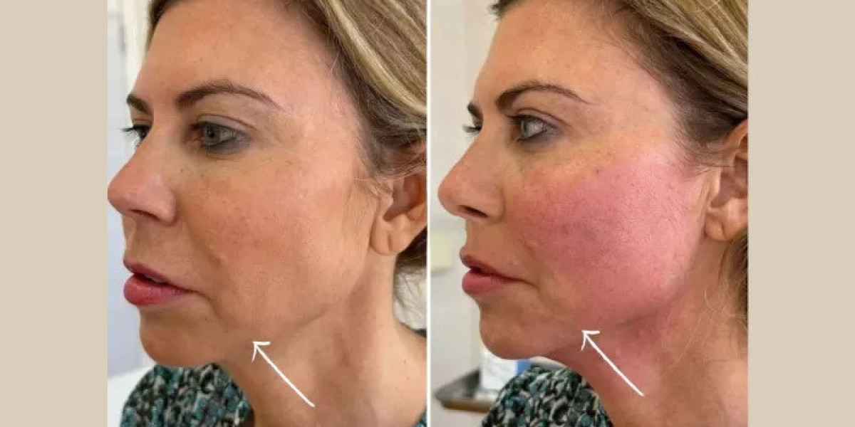 Endolift Treatment in Dubai for Firmer and Smoother Skin