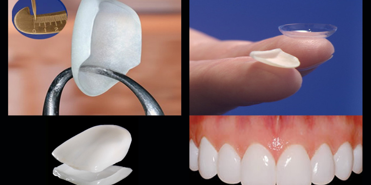 Everything You Need to Know About Porcelain Veneers Before Treatment