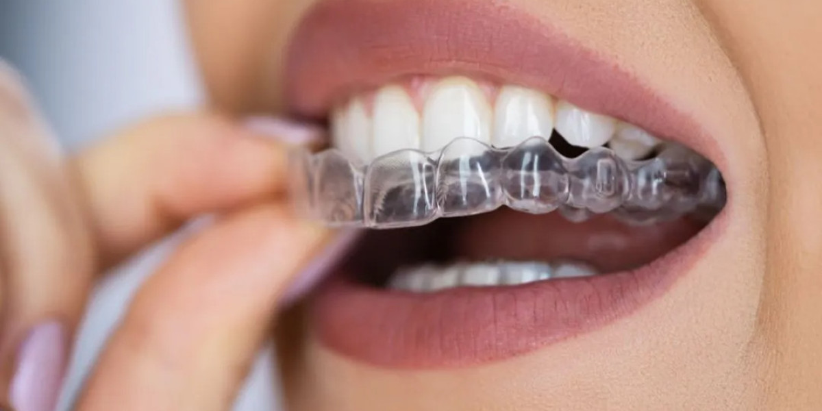 How Clear Aligners Work: Step-by-Step Treatment Guide