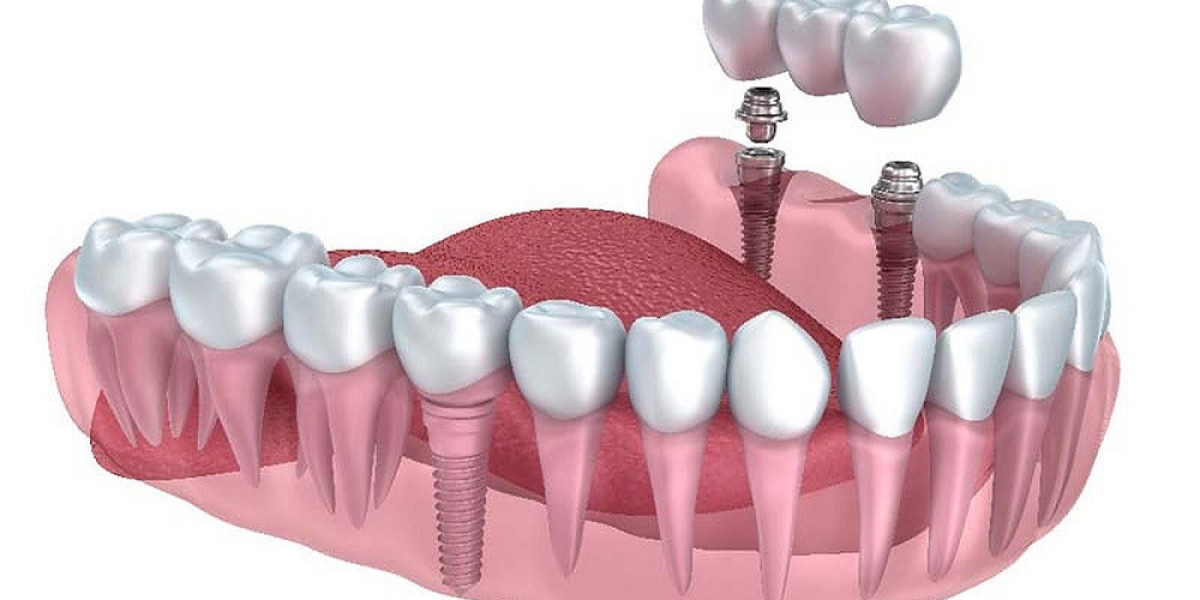 The Role of High-Quality Materials in Successful Implant Restorations