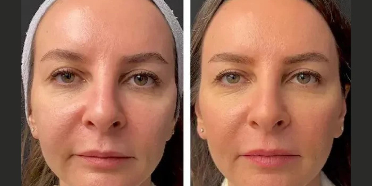 How Many Sessions of Mesotherapy Treatment in Dubai Do You Need?