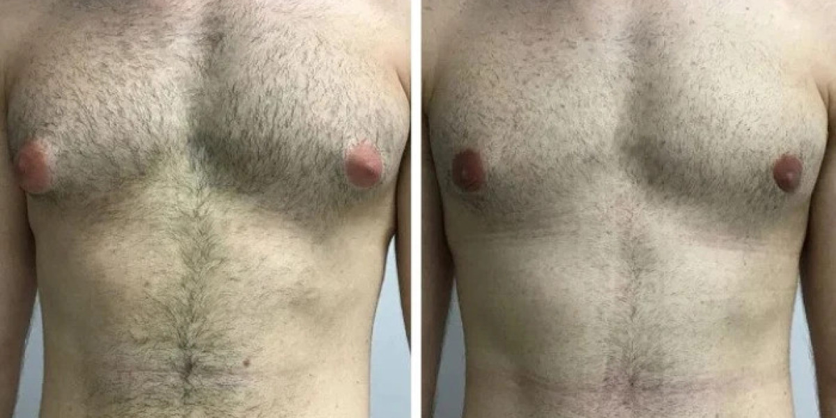 Best Doctors in Dubai Reveal the Latest Advances Gynecomastia Surgery Techniques