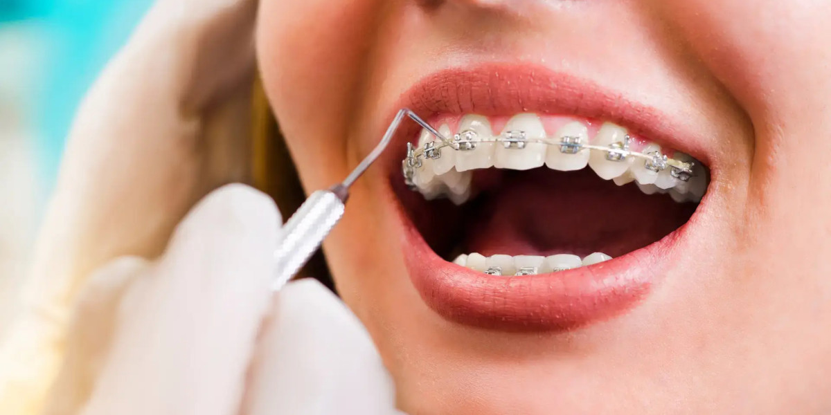 How Traditional Braces Improve Bite Alignment and Dental Health