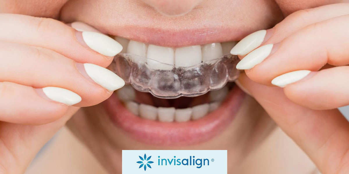 Benefits of Choosing Invisalign for a Straighter Smile