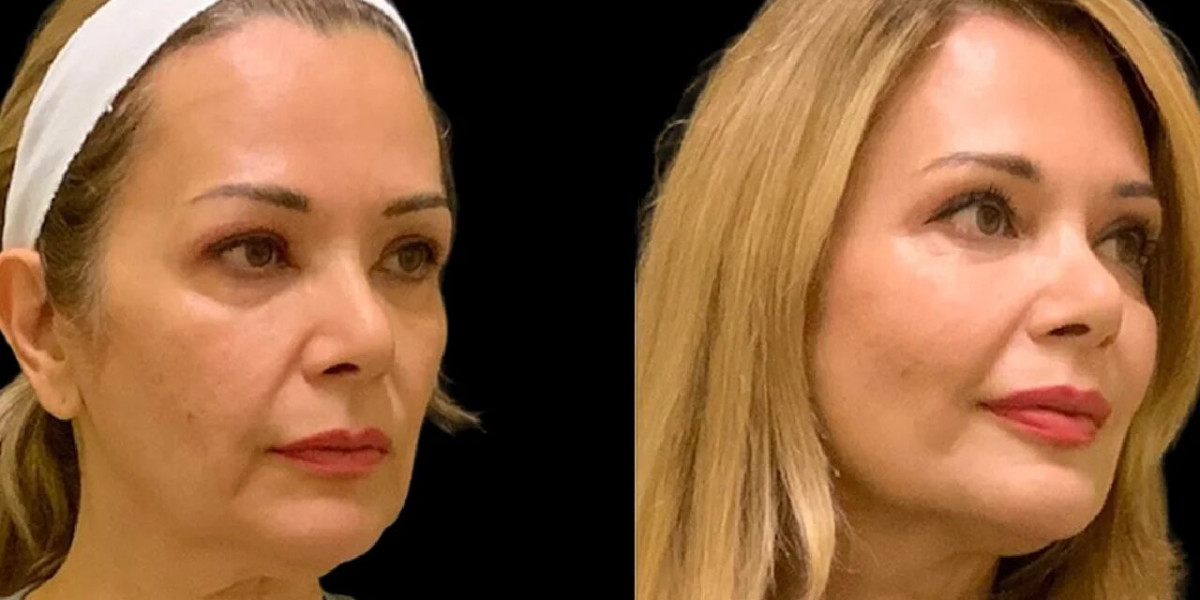 Cheek Fillers Treatment in Dubai Ideal for Special Occasions