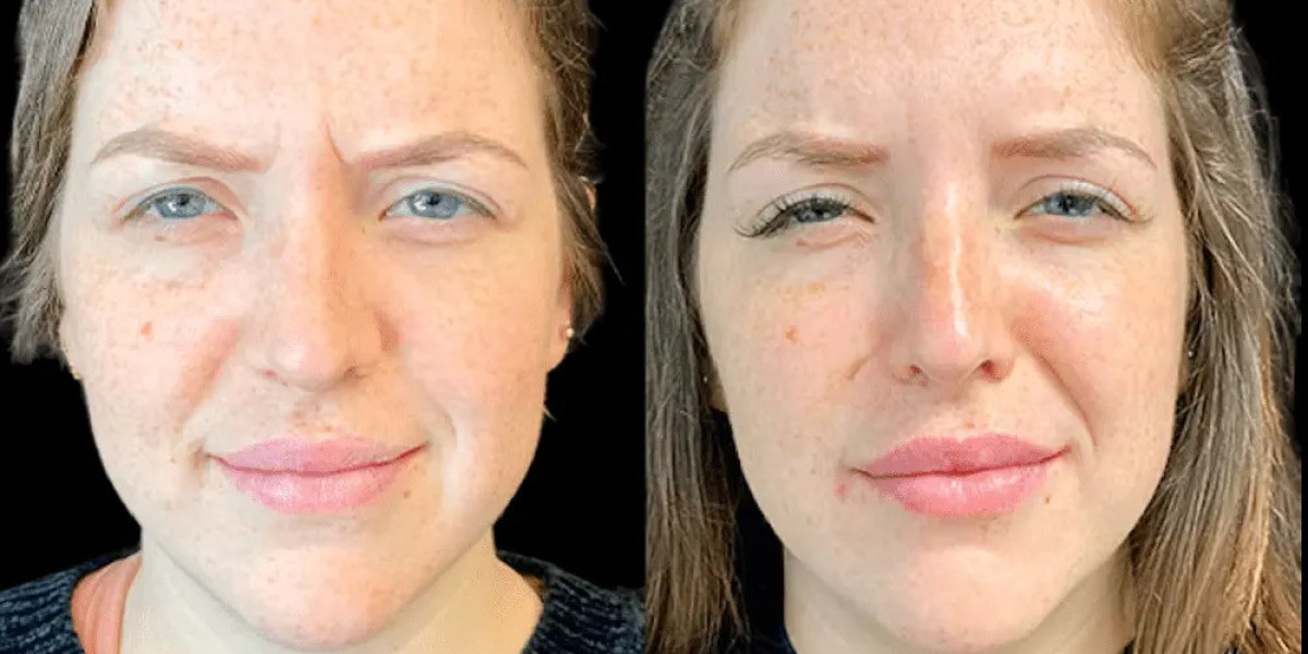 Choosing Best Doctors in Dubai for Botox Matters for Safe & Natural Results