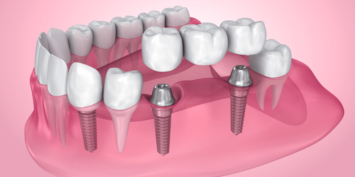 How Dental Bridges Restore Your Smile and Confidence