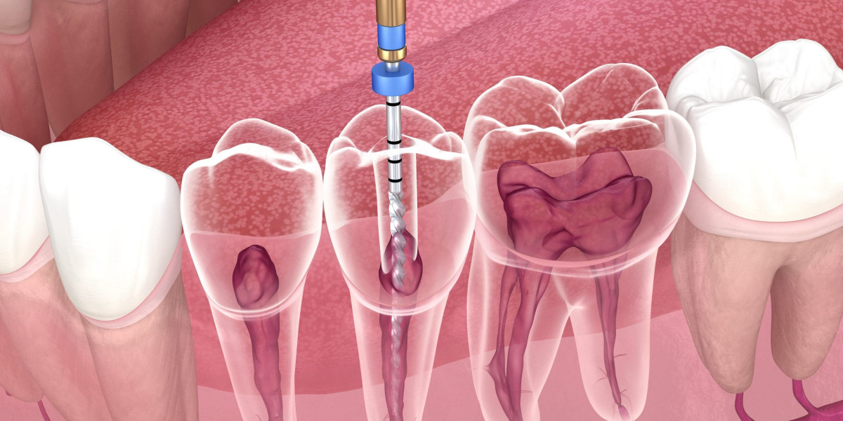What Is Endodontics? A Complete Guide to Root Canal Treatment