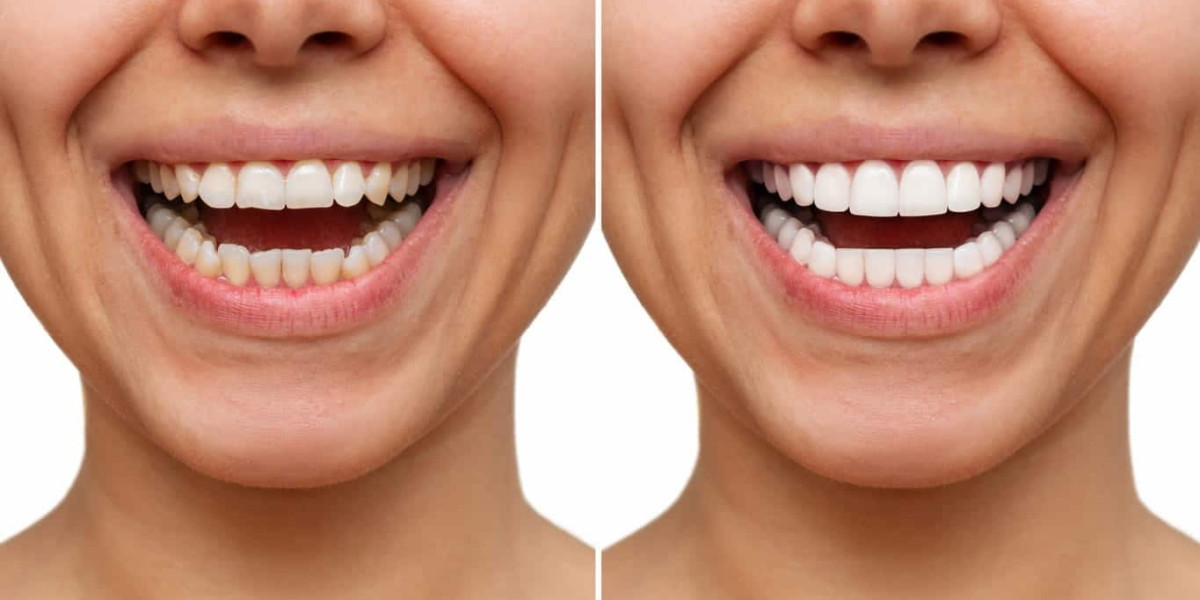 Teeth Whitening for Sensitive Teeth: Best Options and Precautions