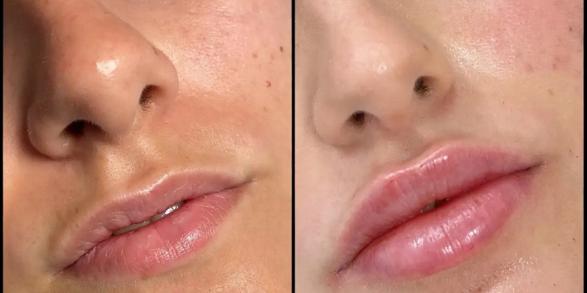 Modern Aesthetic Beauty with Fillers Treatment in Dubai