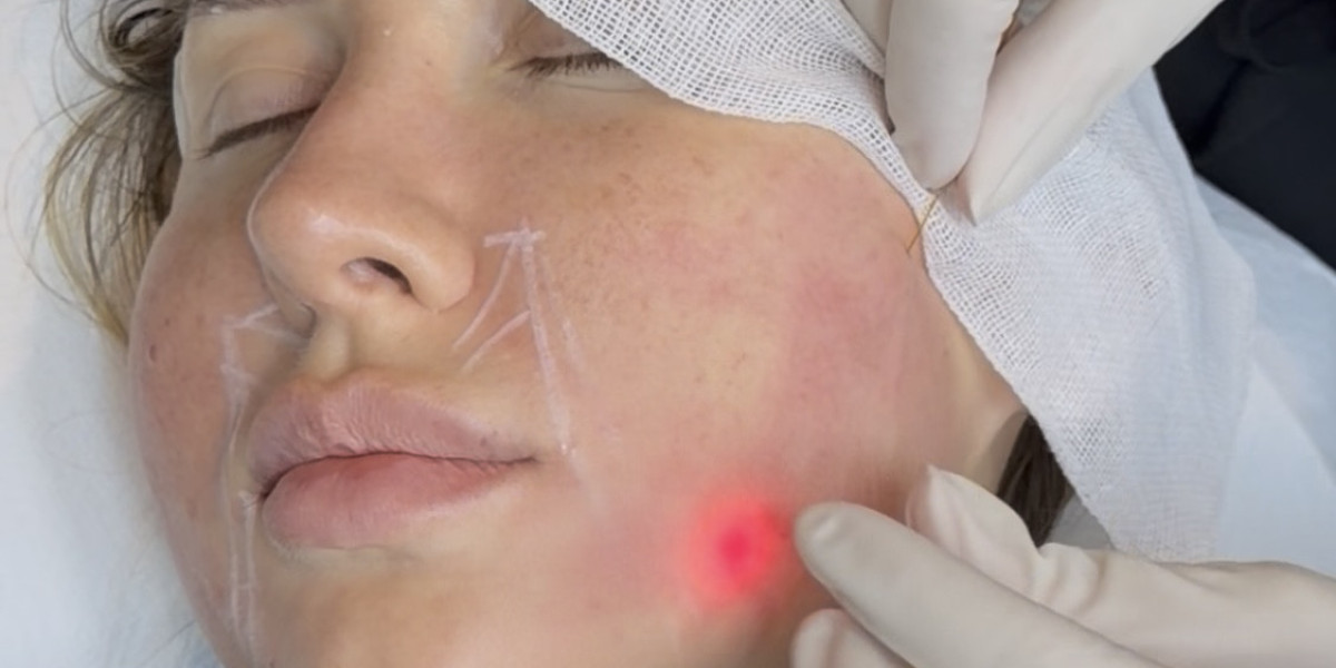 Endolift in Dubai: The Skin Tightening Treatment That Keeps Things Natural